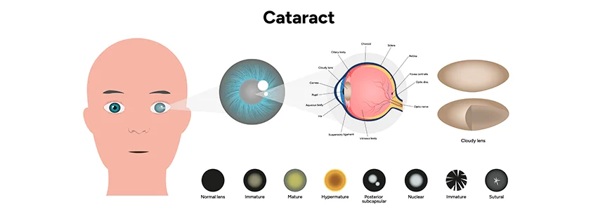 Enfermedad De Catarata