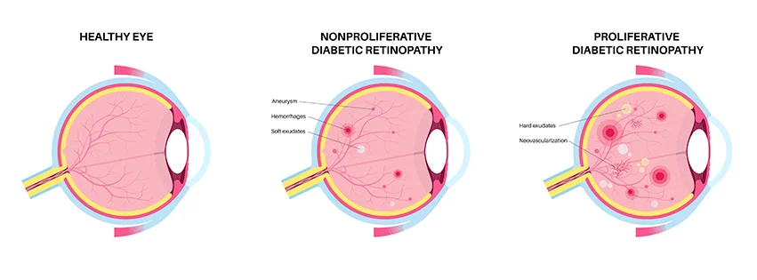 Enfermedad De Retinopatia Diabetica